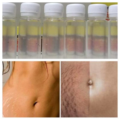 Traitement vergetures 