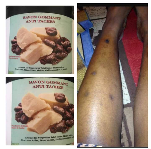 Savon gommant réparateur anti tâche pour tout vos soucis de peau( tache ,cicatrices,rides ,peaux sèche)disponible pour vous redonner une peau saine et uniforme👌👌 comme celui d'un nouveau-né